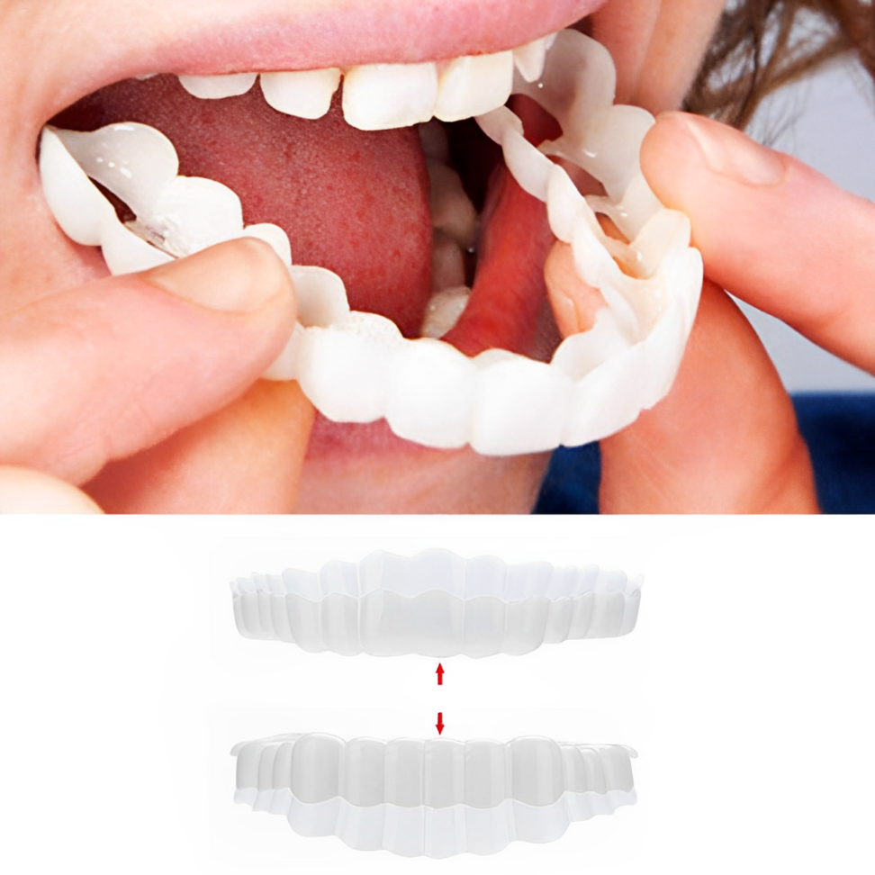 Smile Veneer (Ober- & Unterkiefer Inklusive)