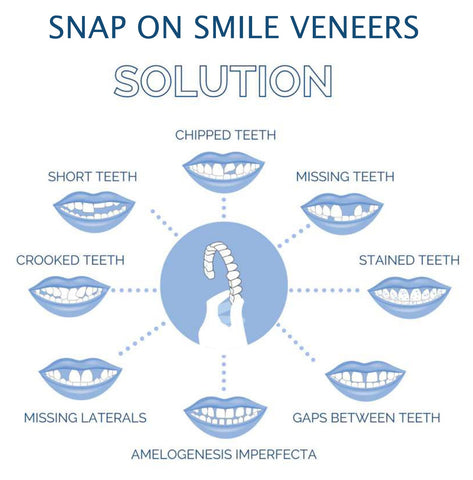 Smile Veneer (Ober- & Unterkiefer Inklusive)
