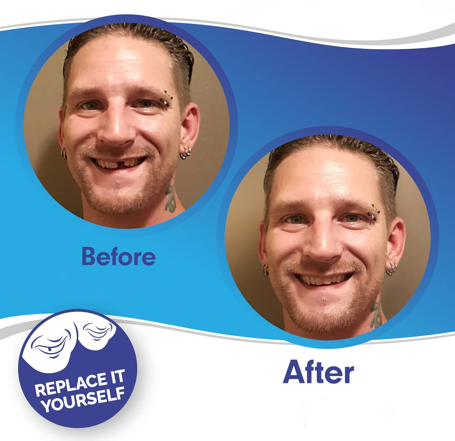 Smile Veneer (Ober- & Unterkiefer Inklusive)