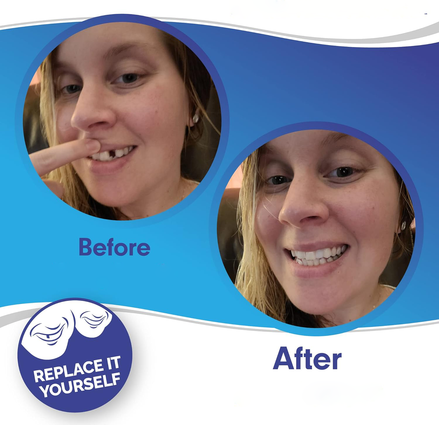 Smile Veneer (Ober- & Unterkiefer Inklusive)